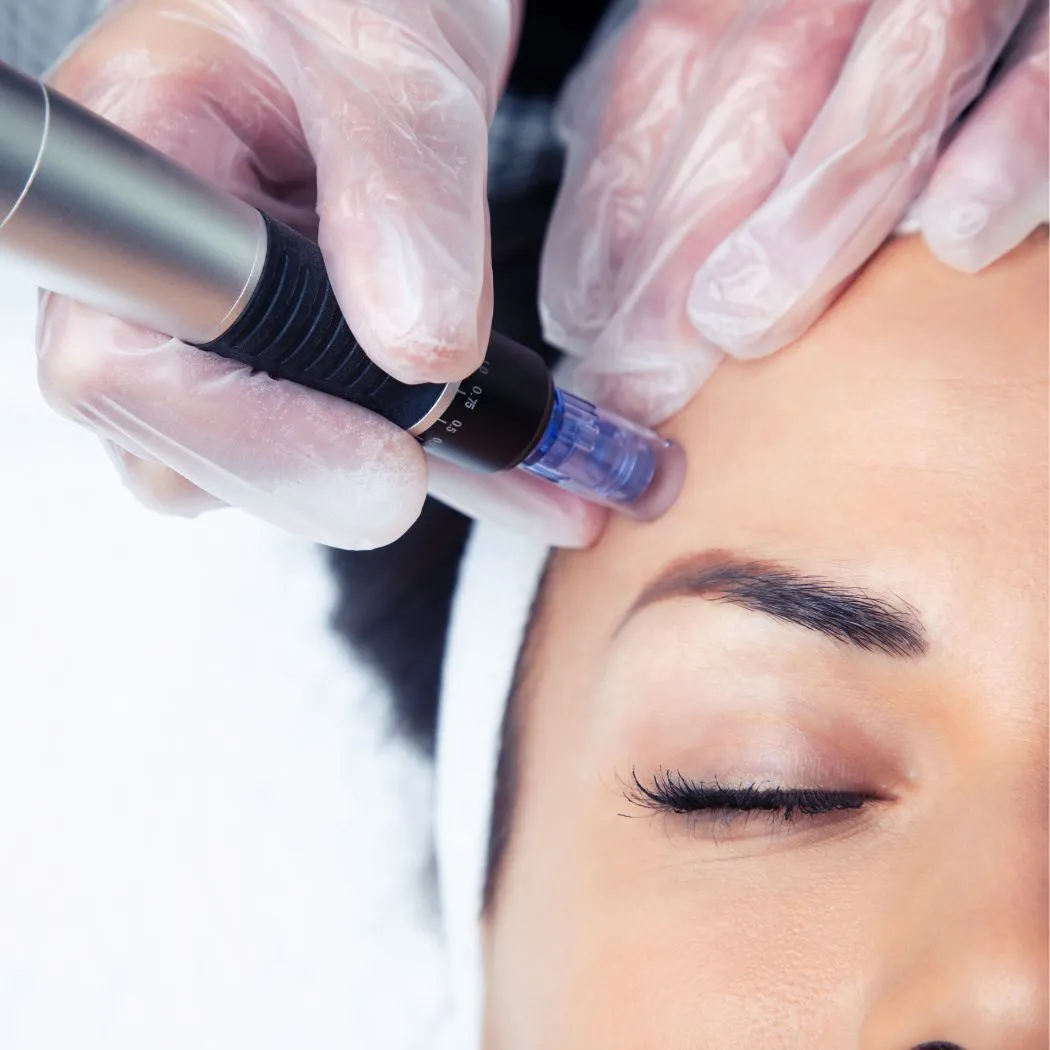 Microneedling-Behandlung mit dem Dermapen an der Stirn bei Belize Beauty in Hamburg-Eppendorf