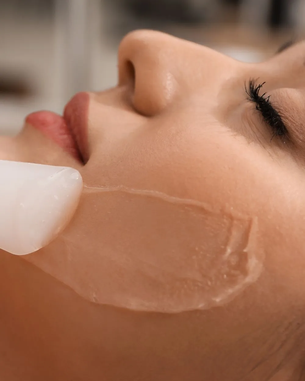 Medizinisches Peeling bei Belize Beauty in Hamburg-Eppendorf